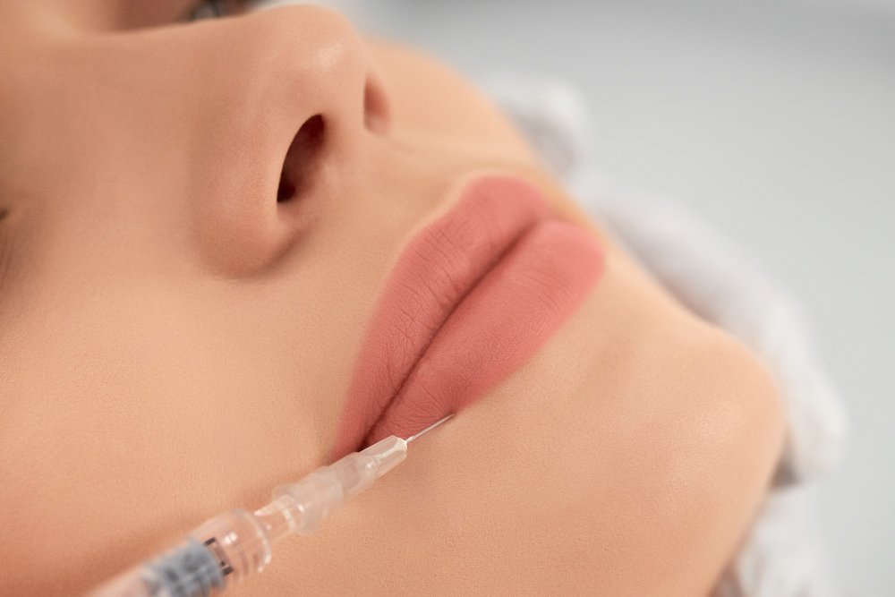 Avoiding Lip Filler Migration: Tips for a Perfect Pout